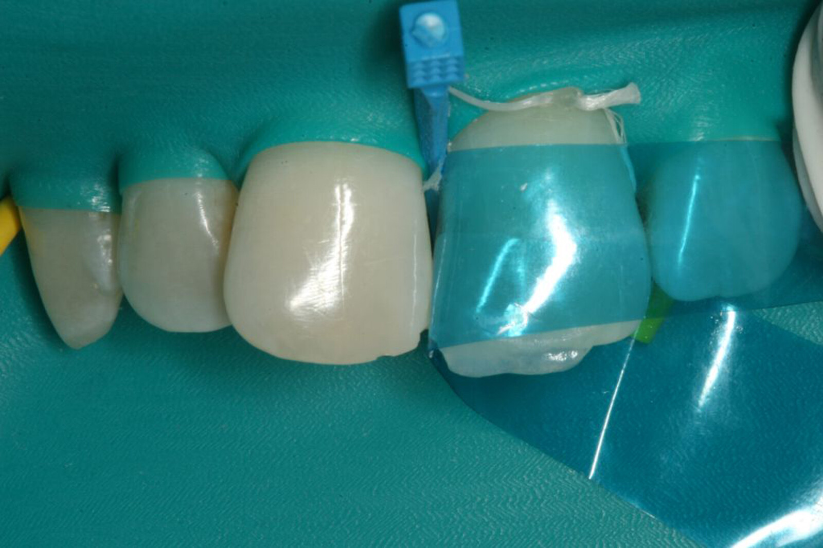 Dental Blue Tint View Matrix Contoured Anterior Matrices Mylar Anatomical Strip