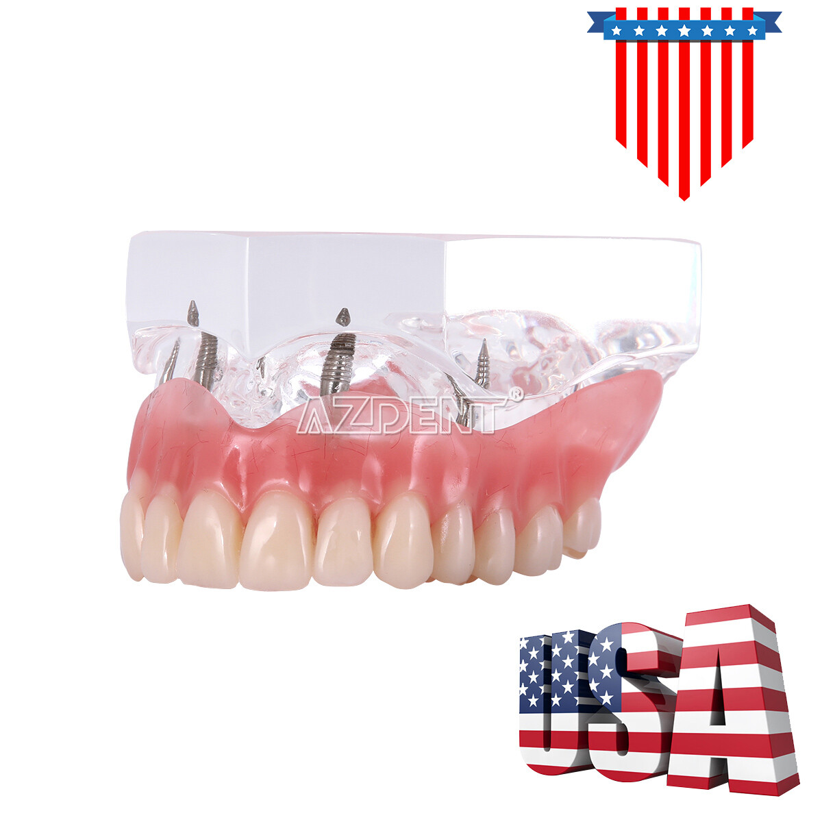 Dental Implant Teeth Model Demo Overdenture Restoration With 2 / 4 Implants