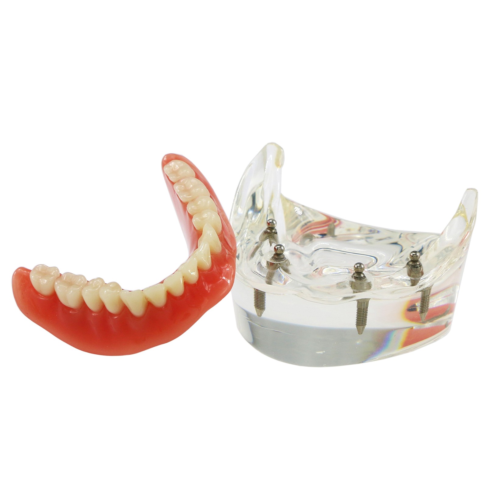 US Dental Model Clear Upper Lower 4 Implants Overdenture Restoration Removable