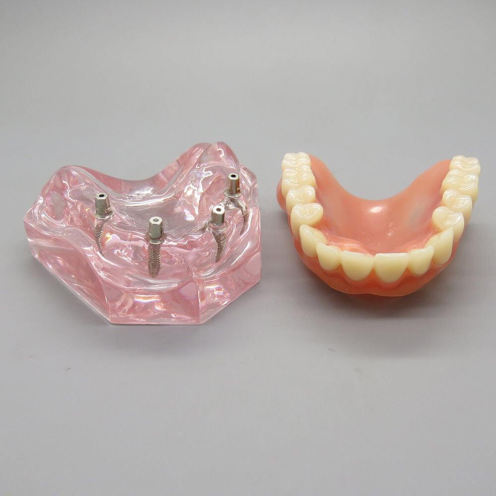 Dental High Quality Model of Upper Teeth Dentures Superior 4 Implants Maxillary
