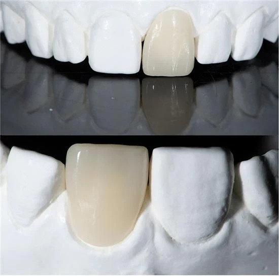 C14 Dental Lithium Disilicate Glass Ceramic Block LT CAD/CAM CEREC Emax 5Pcs/Box