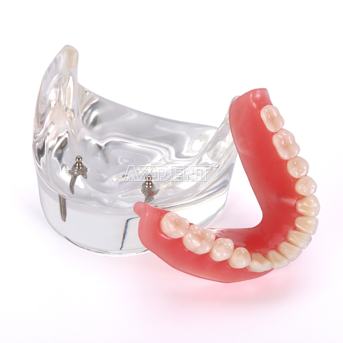 Dental Implant Teeth Model U/ L Demo Overdenture Restoration w/ 2 4 Implants