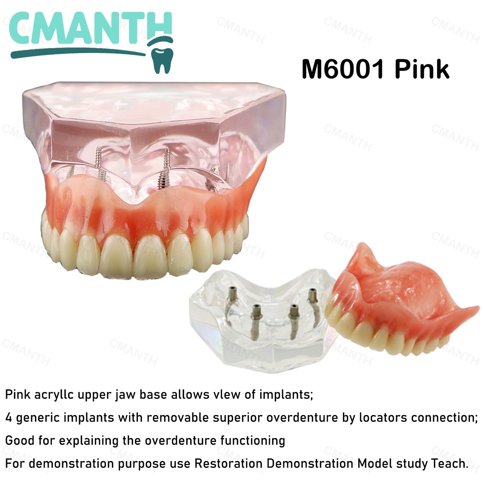 Dental Teeth Model Upper Lower Tooth 4 Implants Restoration Overdenture Model
