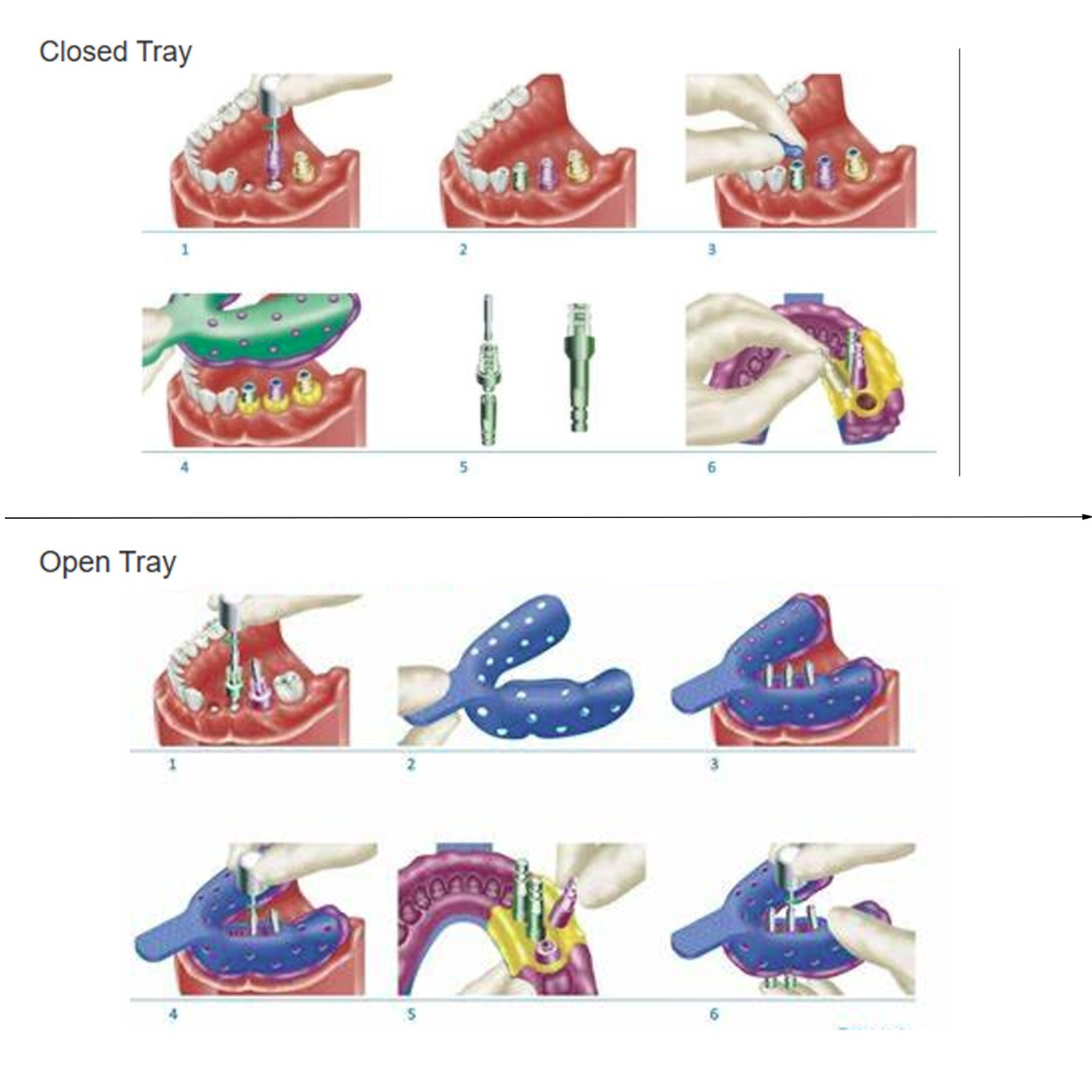 US Hiossen ET Dental Impression Coping Open Pick-up Closed Tray Transfer Analog