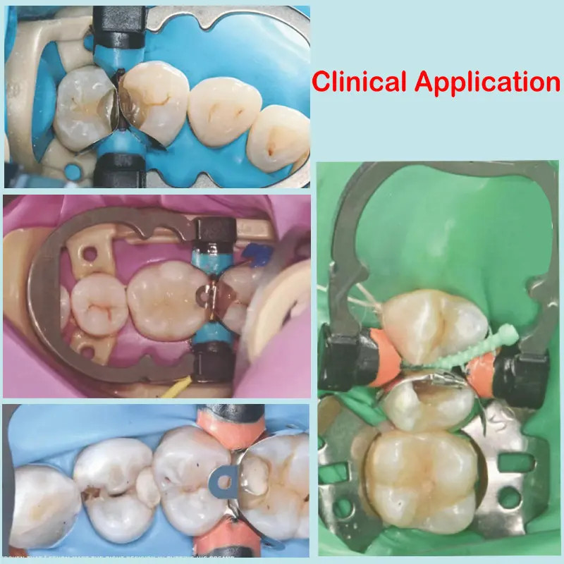 Dental Matrix System Ring R5 Band Nickel Titanium Garrison Palodent V3 System