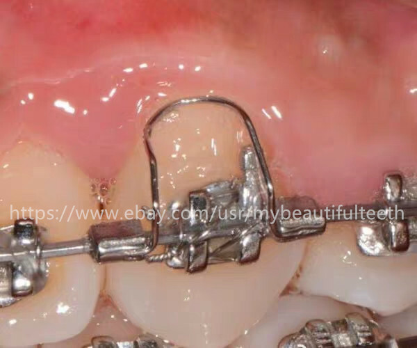Dental Orthodontic Anterior Teeth Torque Spring Rectangular Arch Wire Springs LM