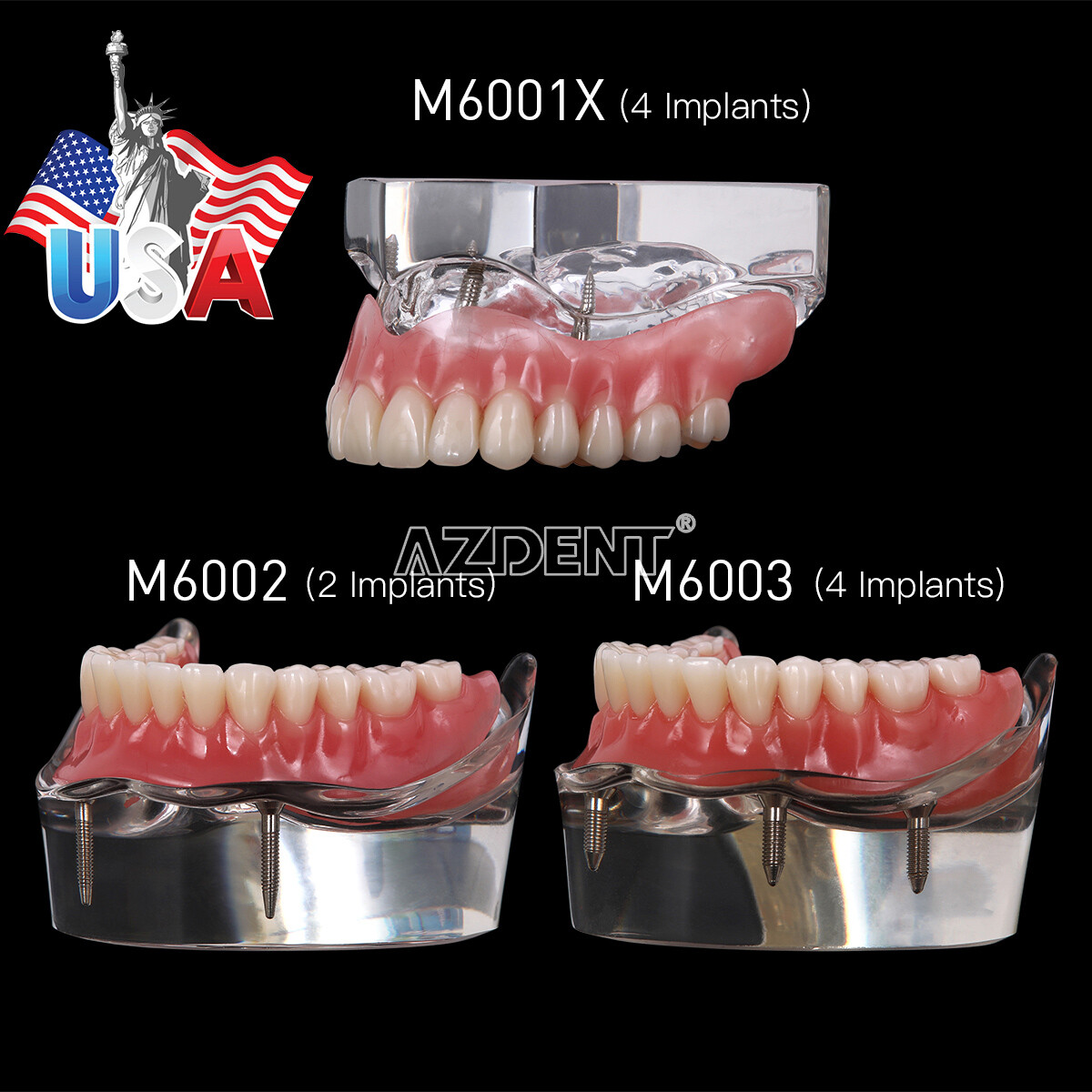 Dental Implant Teeth Model Demo Overdenture Restoration 2 / 4 Implants Upper Low