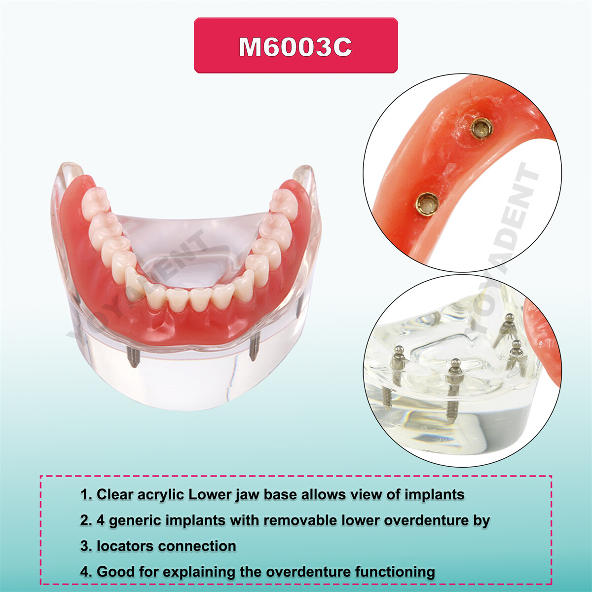 Dental Implant Teeth Demo Overdenture Restoration With 4 Implants Upper/Lower US
