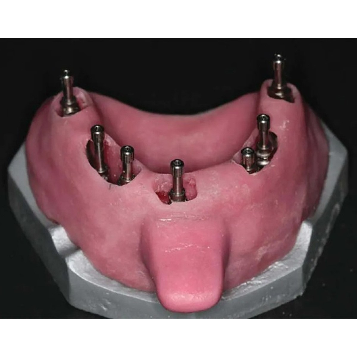 US Nobel Dental Impression Coping Open Closed Tray & Lab Analog Fit NP RP Alloy