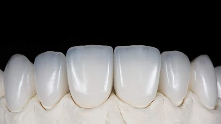 C14 Dental Emax Ceramic Blocks Lithium Disilicate CAD/CAM CEREC Block 5pcs A1 A3