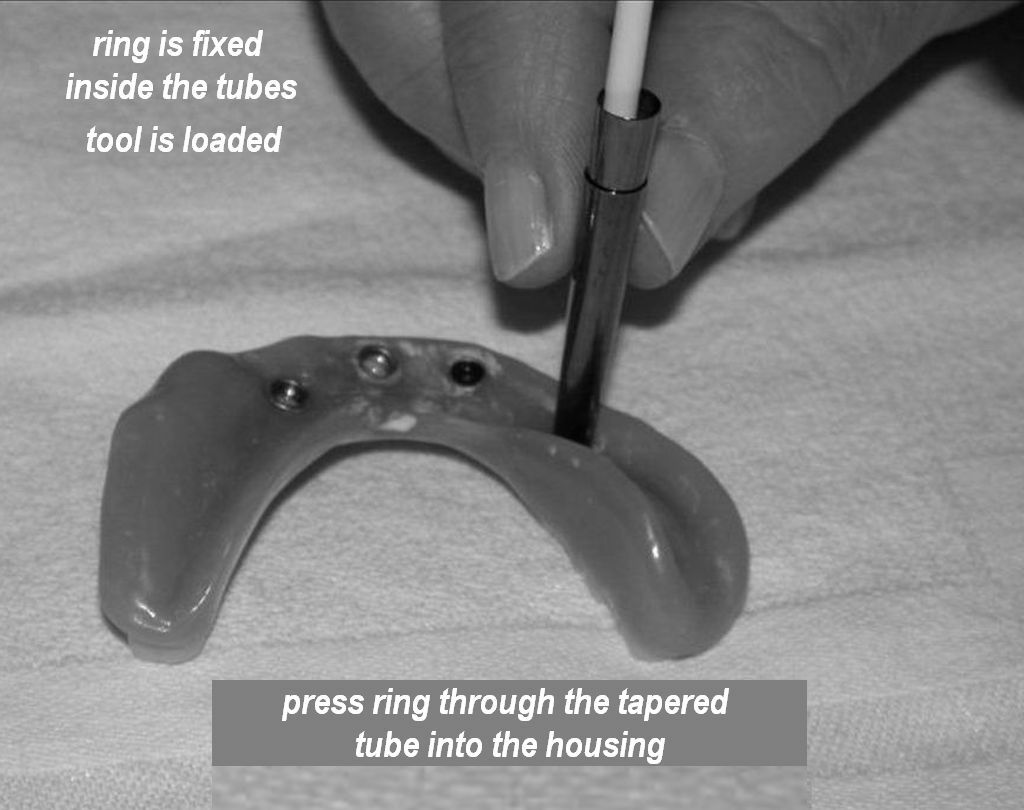 TOOL # 3 for mini dental implant rubber rings comes with 12 * o-rings size 3