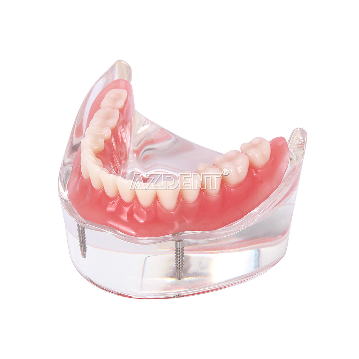 Dental Implant Teeth Model U/ L Demo Overdenture Restoration w/ 2 4 Implants