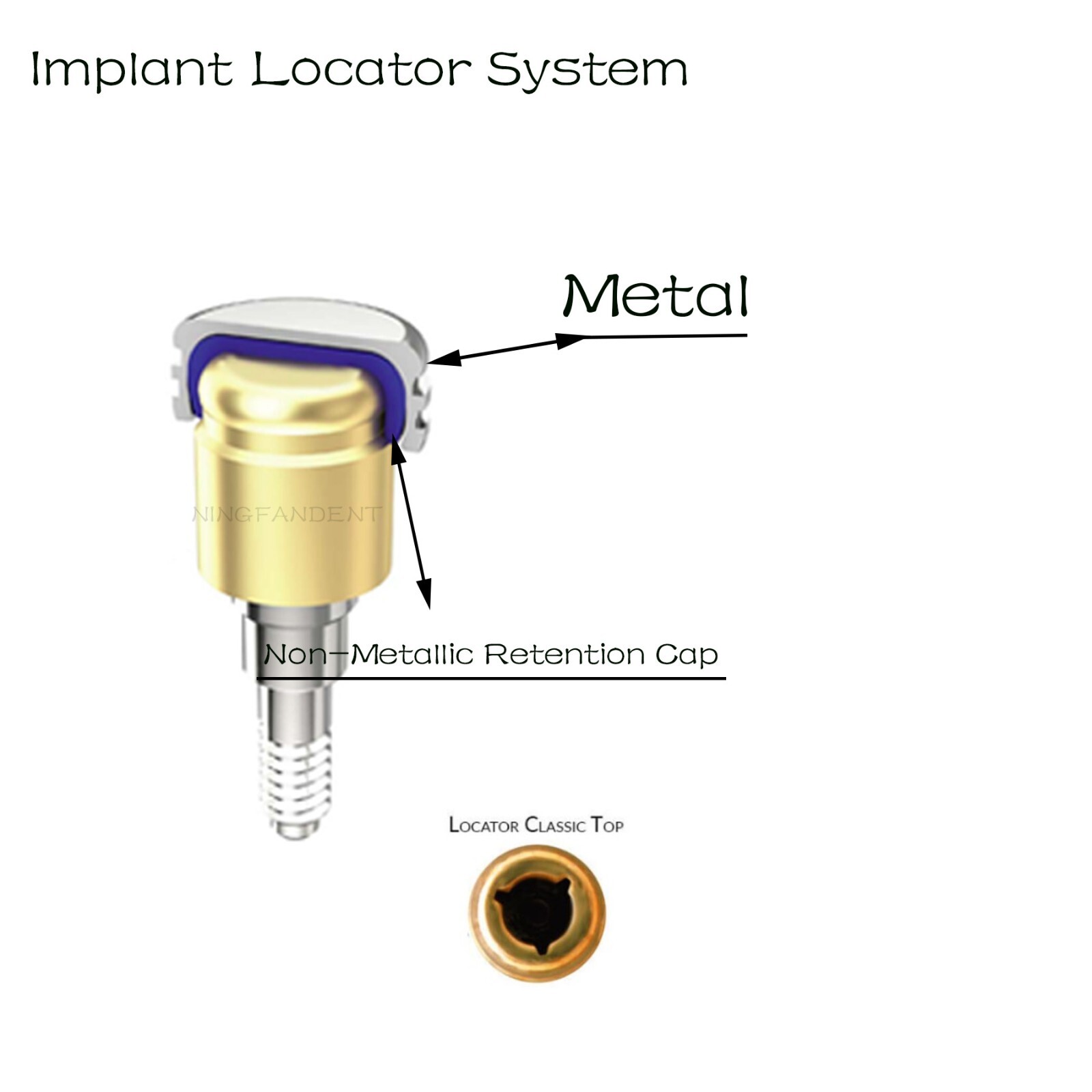 US Dental ZEST LOCATOR Overdenture Abutment For HIOSSEN ET Implant Mini/Regular