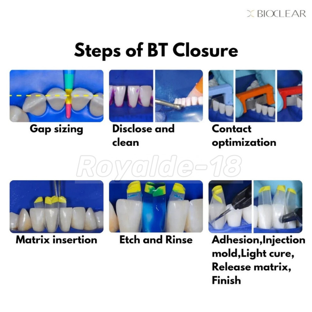 1Box Dental Clear Matrix BT Matrices Black Triangle Wedge Diastema Fits BioClear