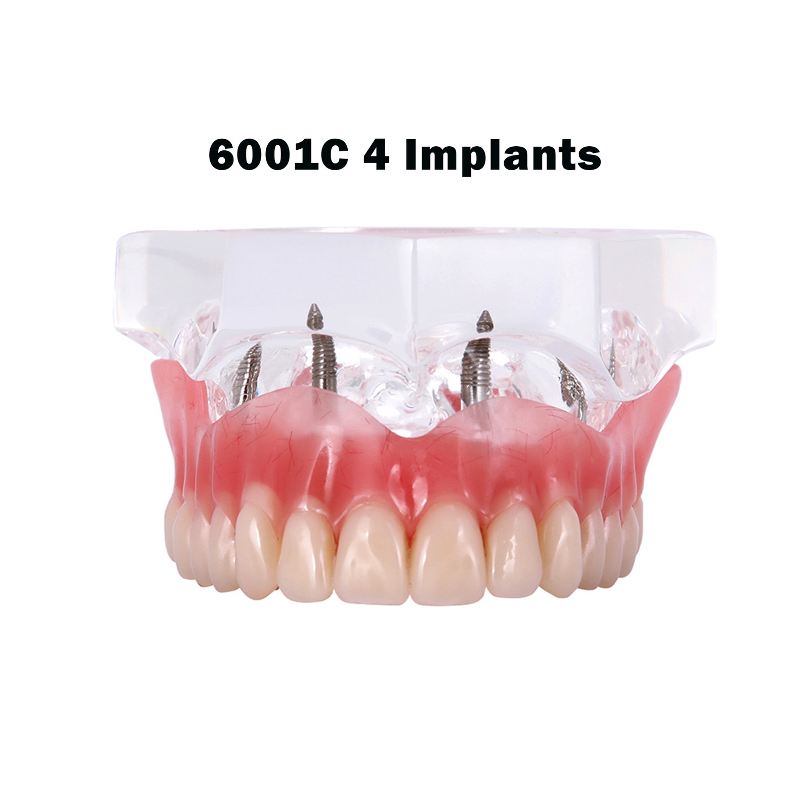 Dental Teeth Model Upper Lower Tooth 4 Implants Restoration Overdenture Model