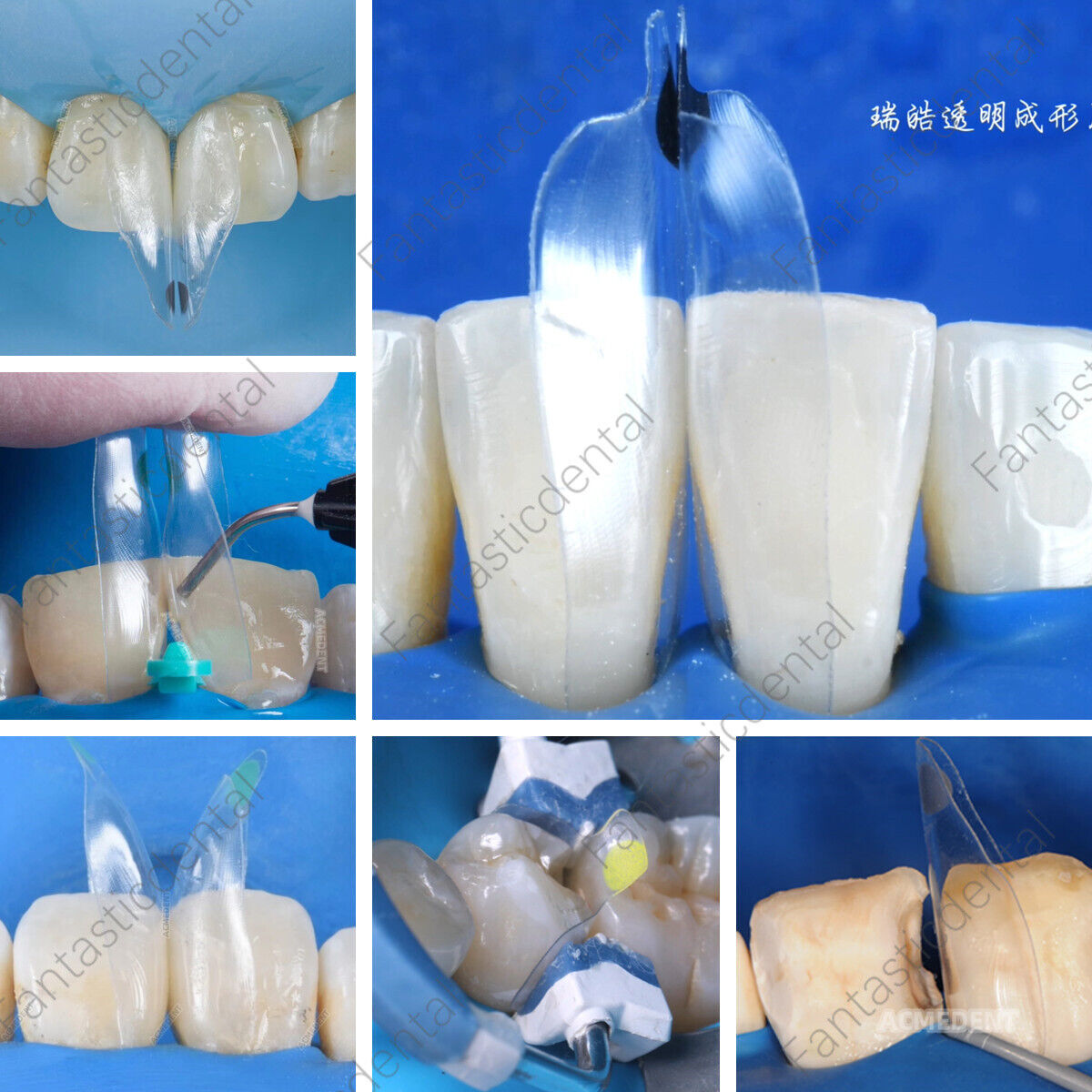 Dental Transparent Matrix Clear Bow Matrice Band Anterior Front Bioclear TorVM