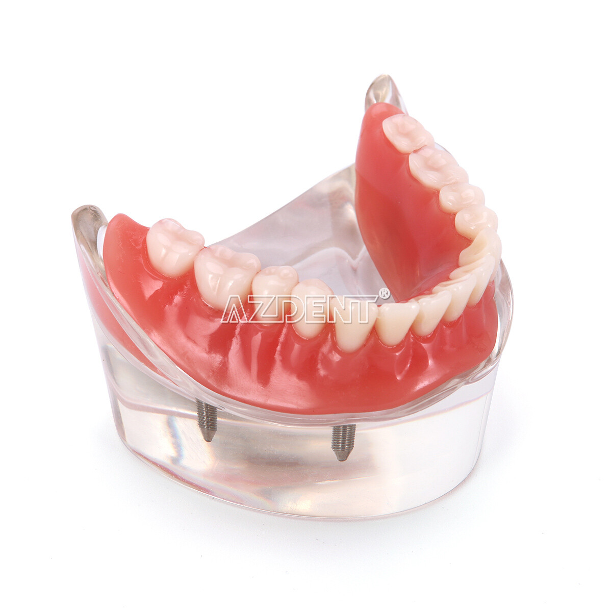 Dental Implant Teeth Model U/ L Demo Overdenture Restoration w/ 2 4 Implants