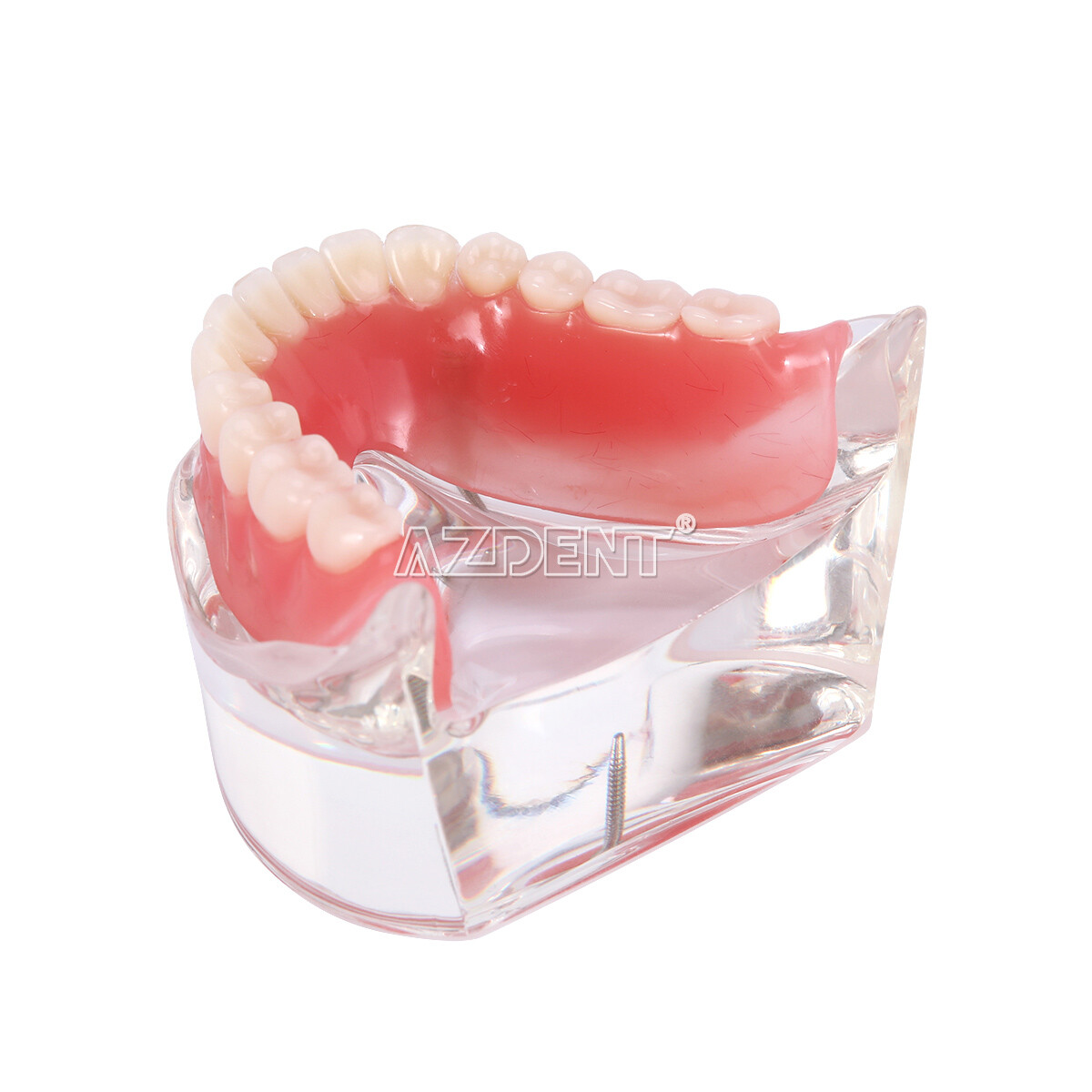 Dental Implant Teeth Model Demo Overdenture Restoration with Implants U/L 2 4