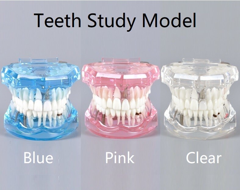 Dental Model Teeth Implant Restoration Bridge Teaching Study Medical Science
