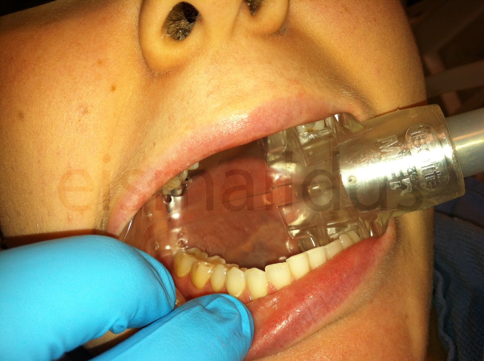 REDUCE DENTAL AEROSOLS; AUTOCLAVABLE 2 MEDIUM DRYSHIELD ISOLATION MOUTH PIECES