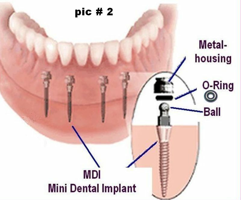 25 + 3 * – my size 1 – rubber O-RINGS for Mini Dental implants 0550 a.o.