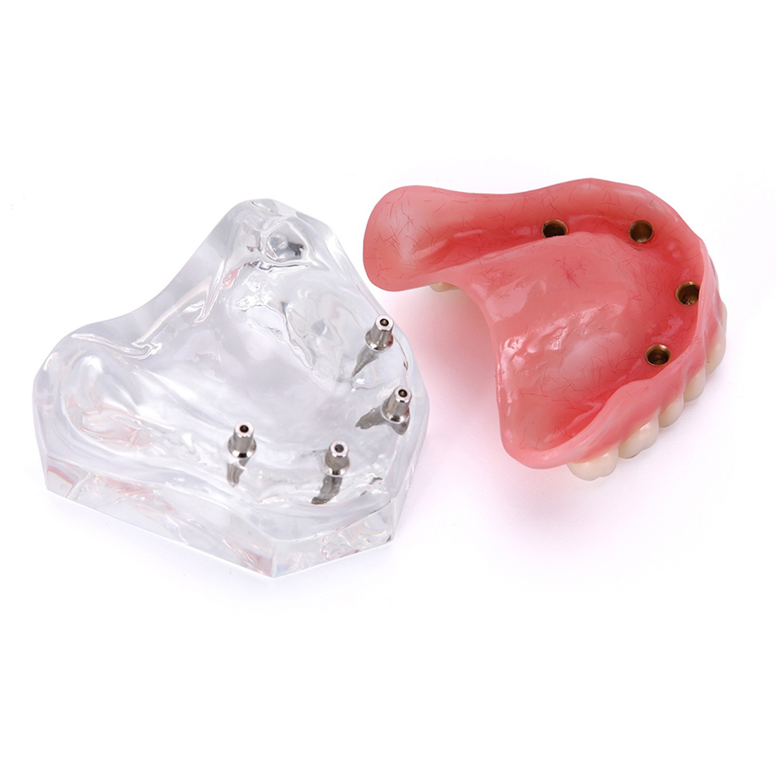US Dental Model Clear Upper Lower 4 Implants Overdenture Restoration Removable
