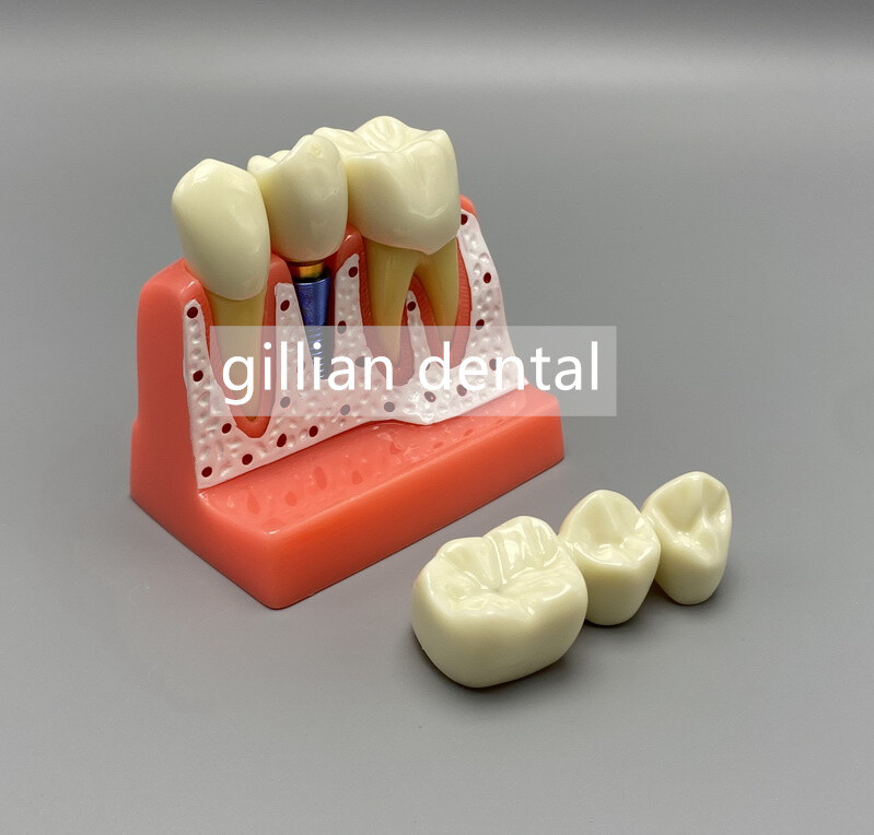 Dental Model Teeth Implant Restoration Bridge Teaching Study Medical Science
