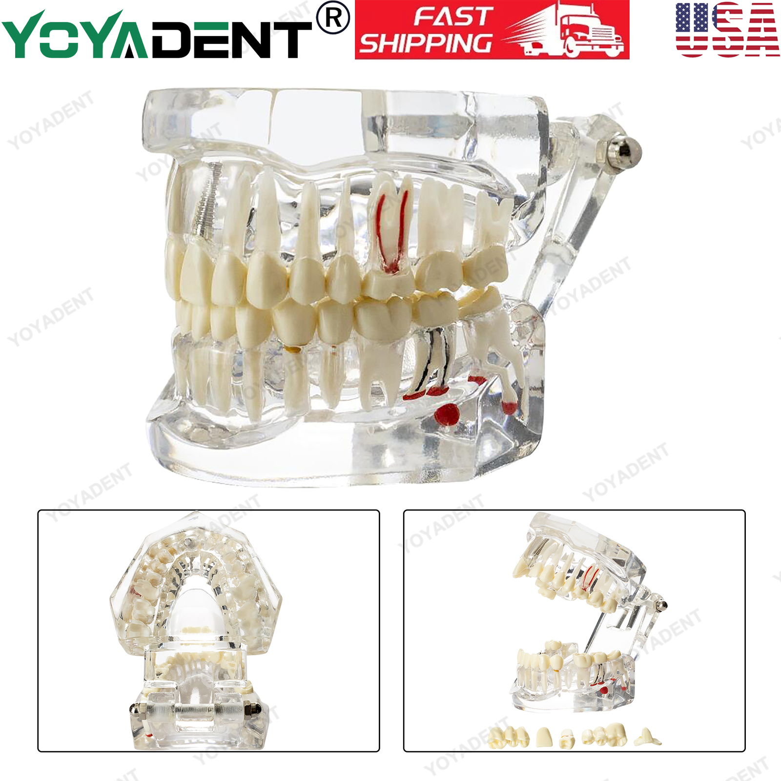 US Dental Teeth Model Ortho Implant Practice Teaching With Implants Demo Model