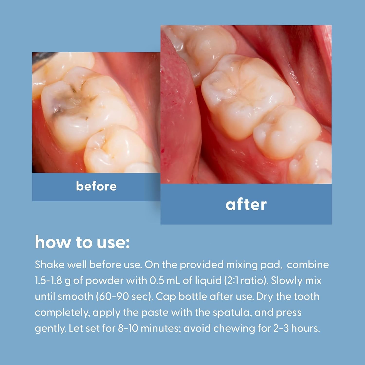 Dental Tooth Repair Kit Temporary Filling Cement for Chips Cracks Missing Teeth