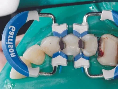 Garrison Dental Composi-Tight 3D Fusion Matrix Rings,Free Shipping