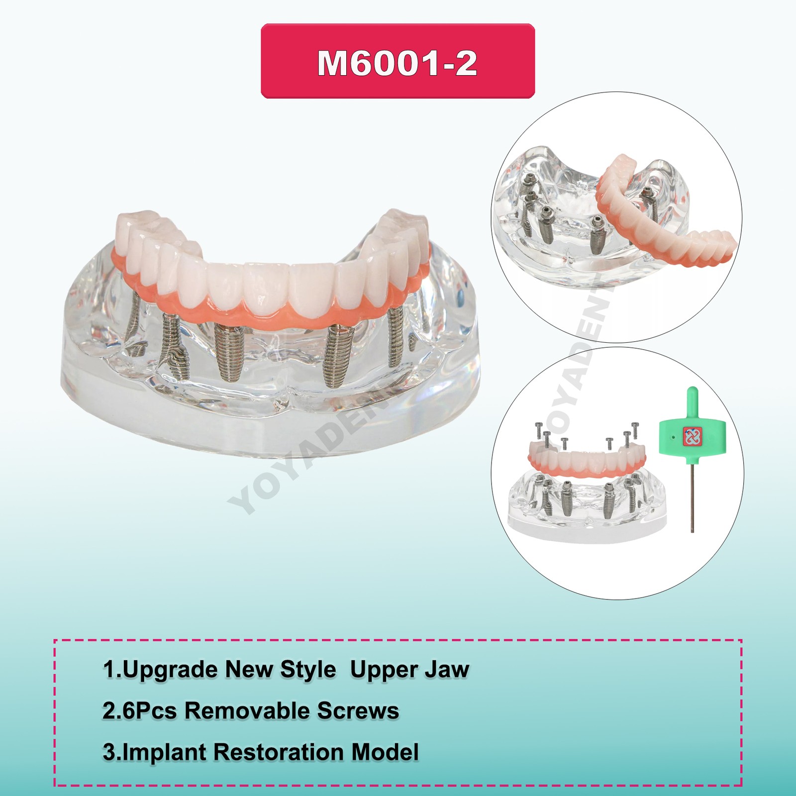 US Dental Teeth Model Overdenture Inferior Implants Demo Upper/Lower Detachable