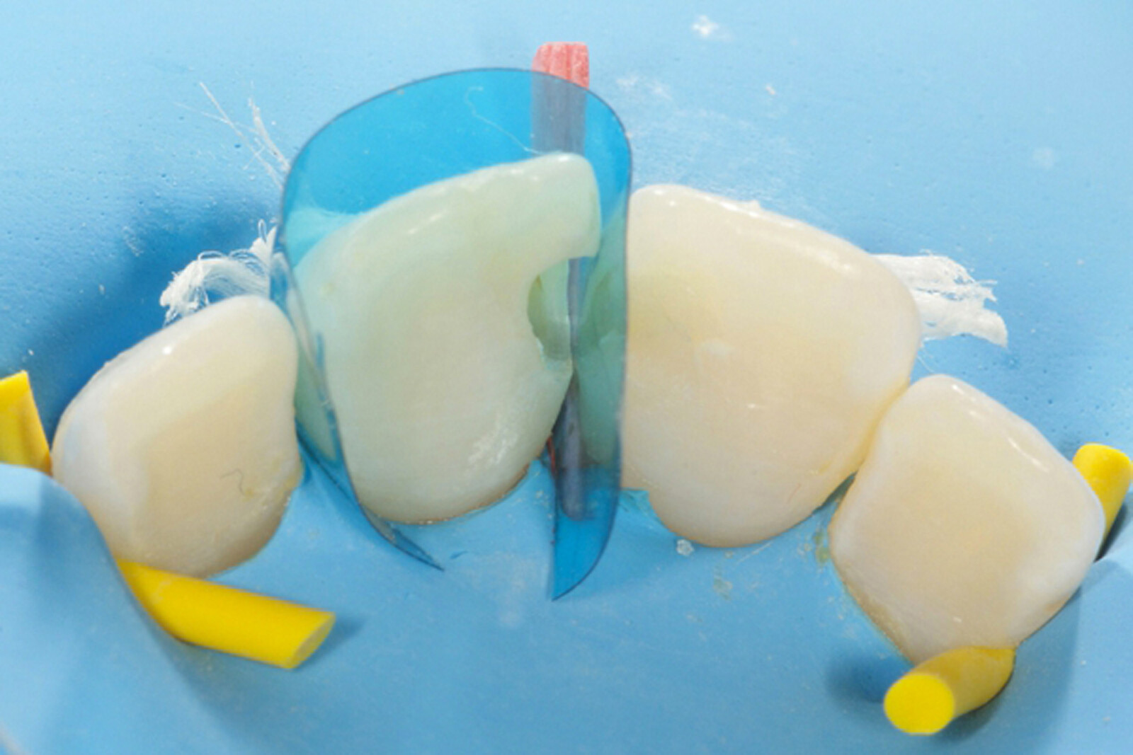 Dental Blue Tint View Matrix Contoured Anterior Matrices Mylar Anatomical Strip