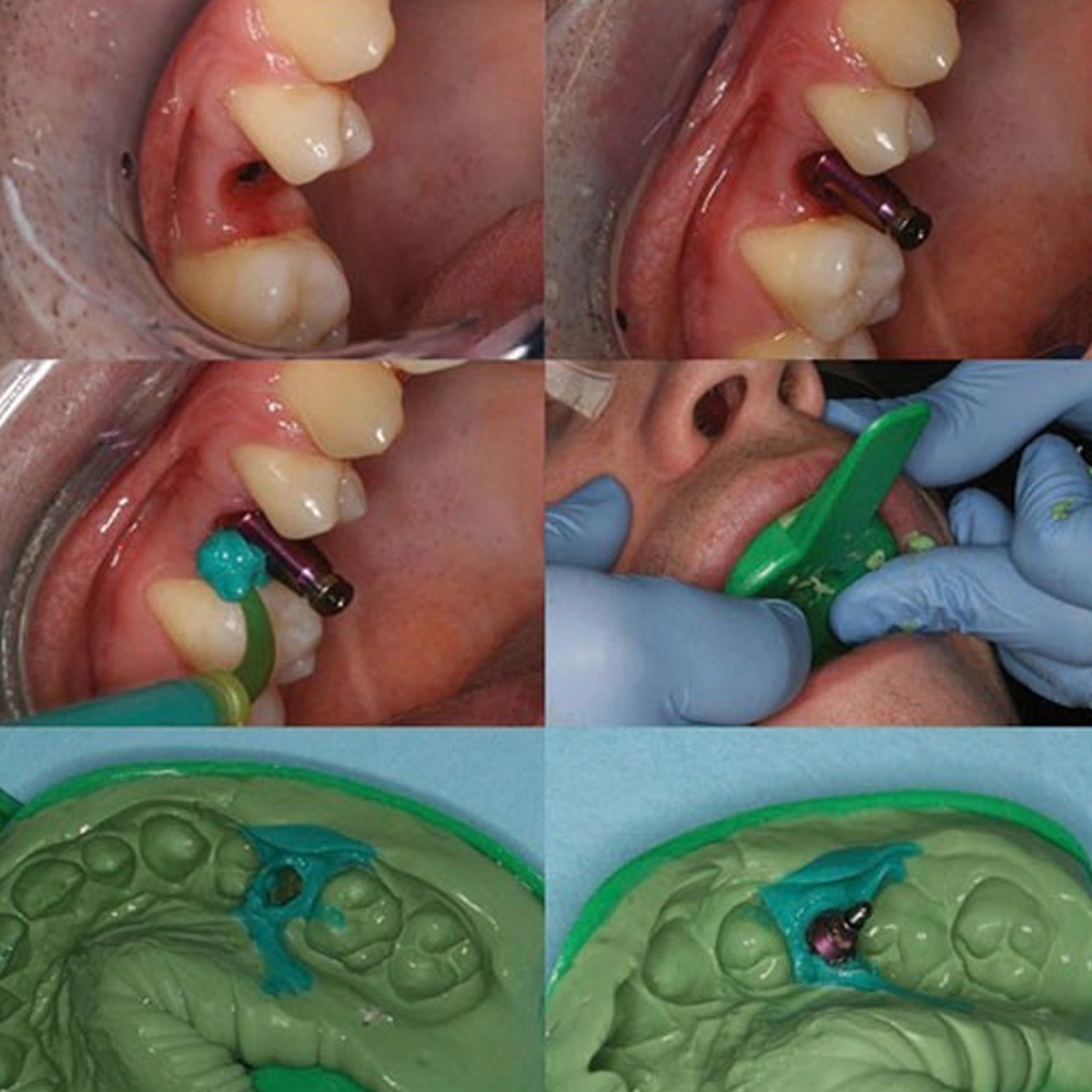 US Nobel Dental Impression Coping Open Closed Tray & Lab Analog Fit NP RP Alloy