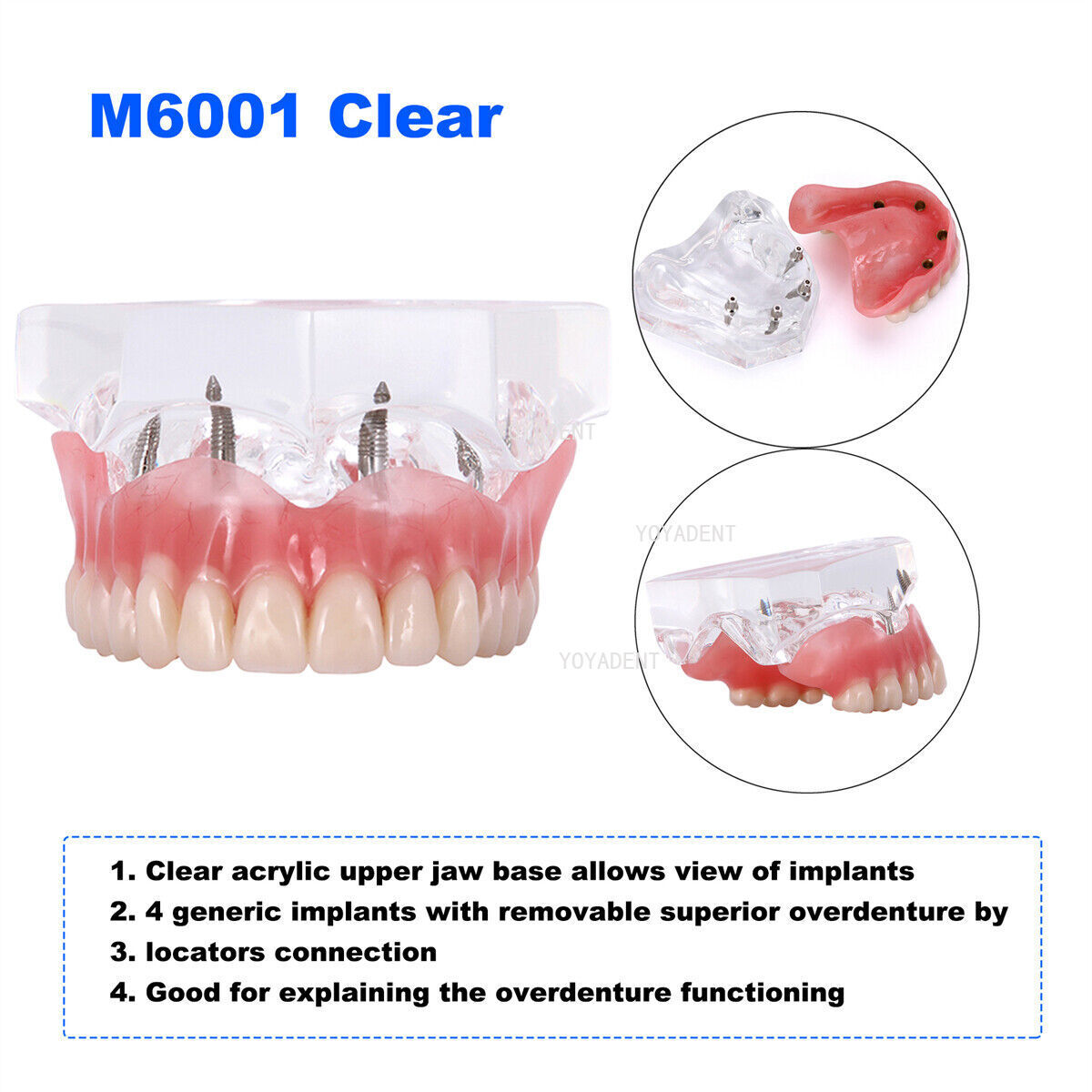 Dental Teeth Model Removable Overdenture Teeth Upper/Lower Jaw 4 Implants Model