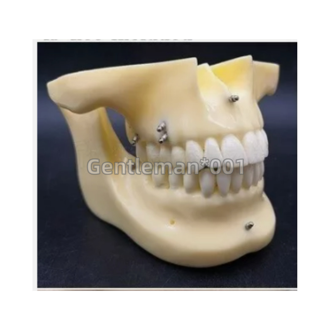 Dental Orthodontic Mini An Implant Micro Screws Titanium TC4 Screw TAS Anchorage