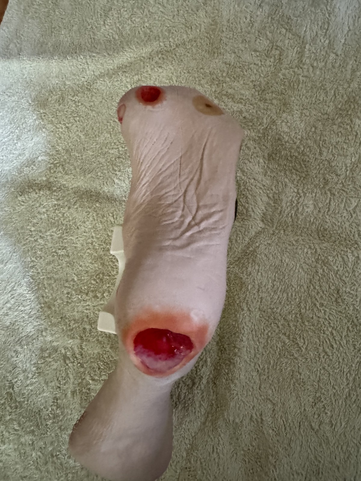 VATA Wilma Wound Foot Teaching Model
