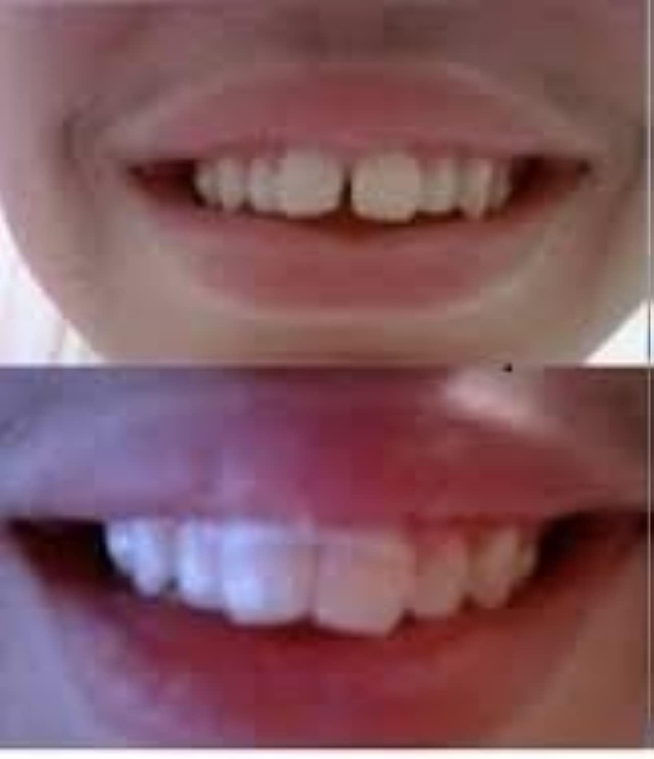 Strong 4.5 Ounce Quality 100pc Teeth Alignment