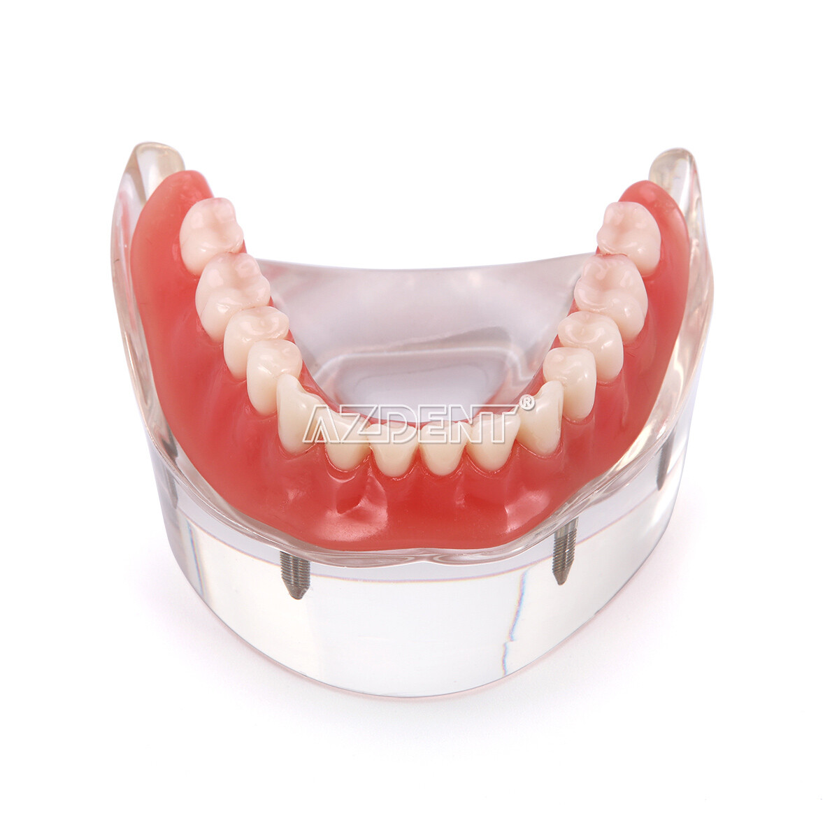 Dental Implant Teeth Model Demo Overdenture Restoration with Implants U/L 2 4