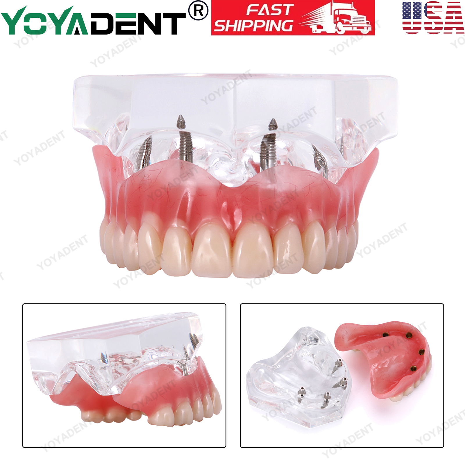 US Dental Teeth Model Ortho Implant Practice Teaching With Implants Demo Model