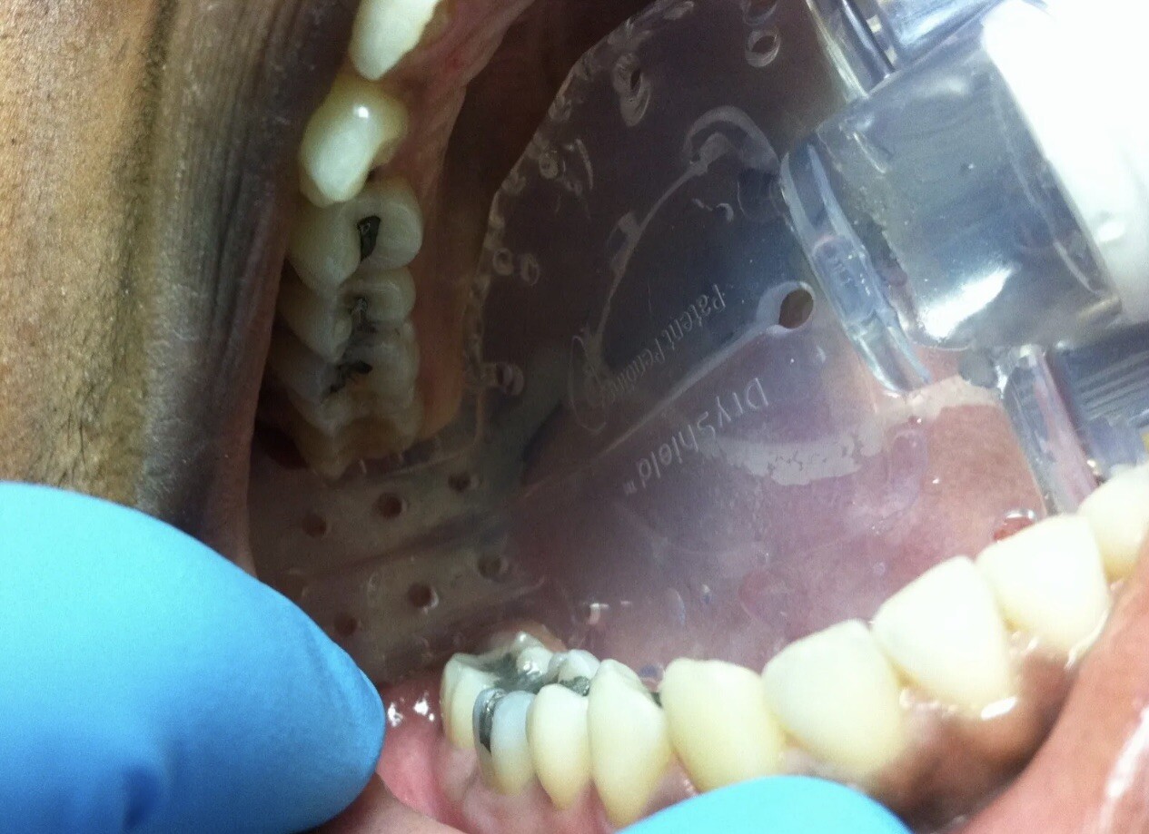 REDUCE DENTAL AEROSOLS; AUTOCLAVABLE 2 MEDIUM DRYSHIELD ISOLATION MOUTH PIECES