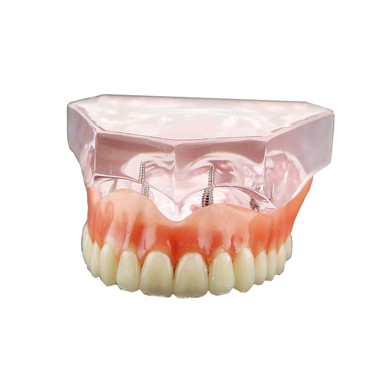 Dental Teeth Model Upper Lower Tooth 4 Implants Restoration Overdenture Model