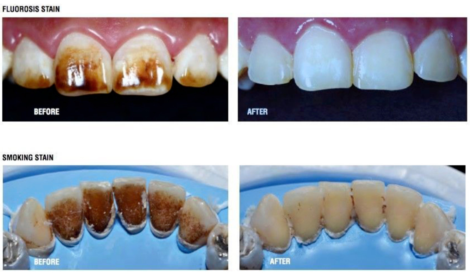Antivet Kit Dental White ning and Enamel Cleaning Kit New Treatment to Fluorosis