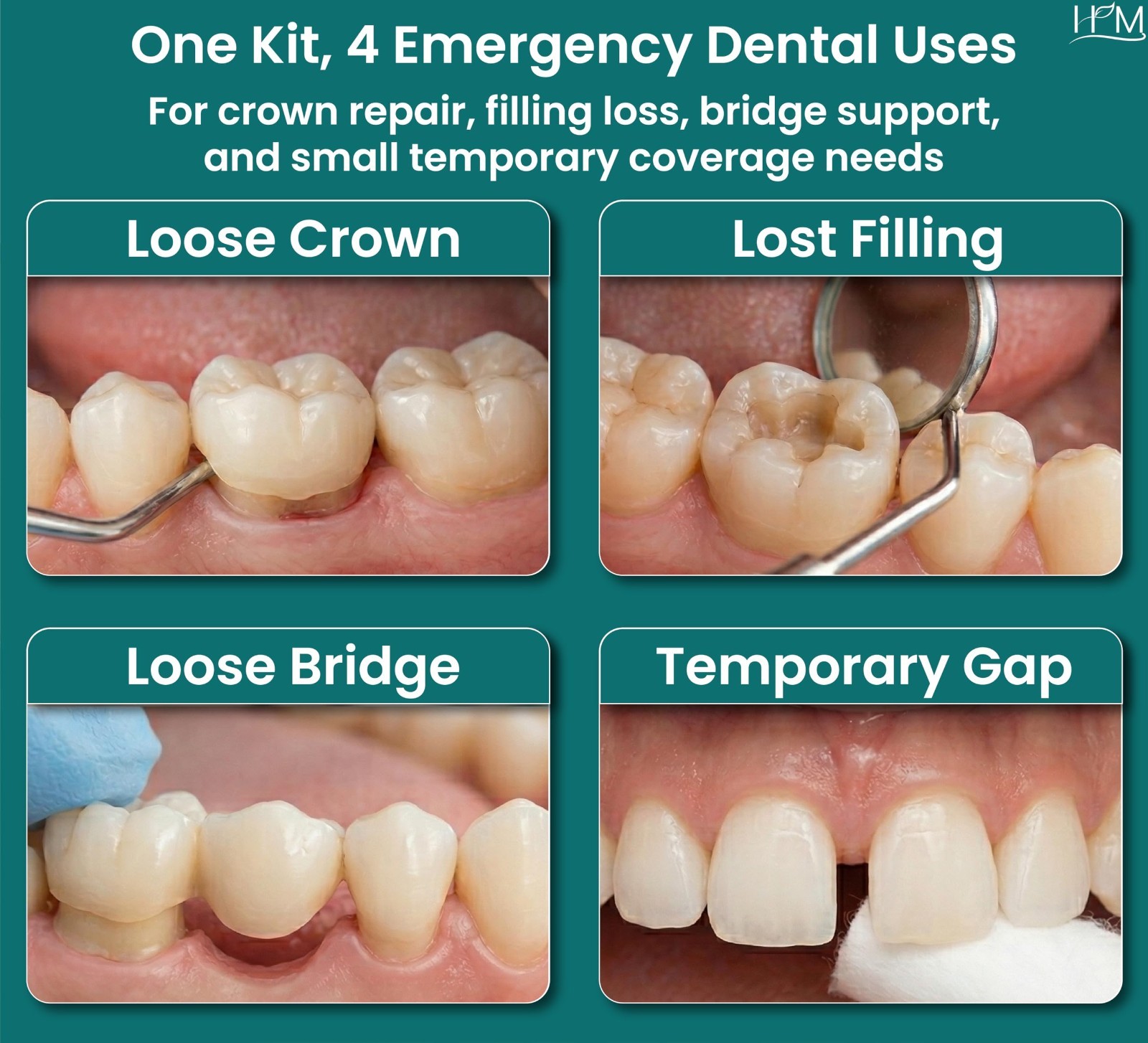 Zinc Oxide Eugenol Dental Cement Kit – Instant Tooth Repair, Crown & Bridge Fill