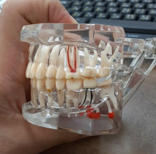 Dental Model Teeth Implant Restoration Bridge Teaching Study Medical Science