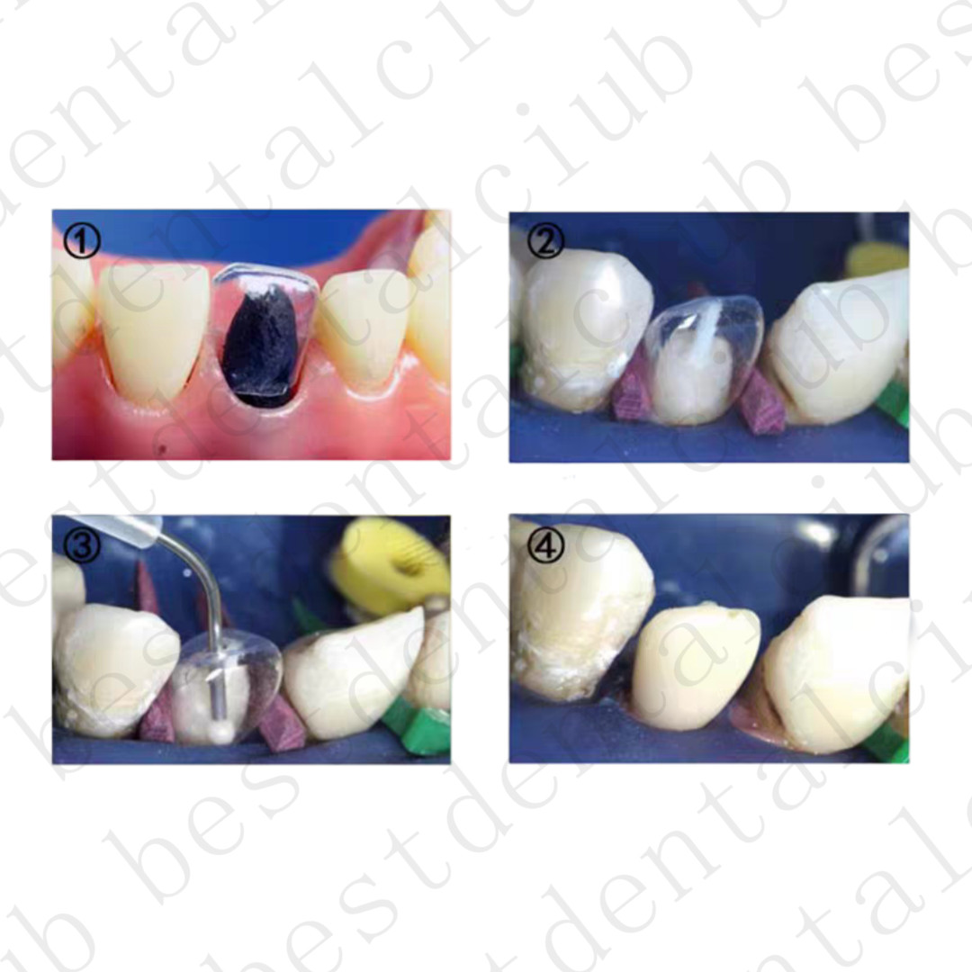 Dental Anterior Transparent Forms For Temporary Crowns No1.910 Kit TOR VM 64Pcs