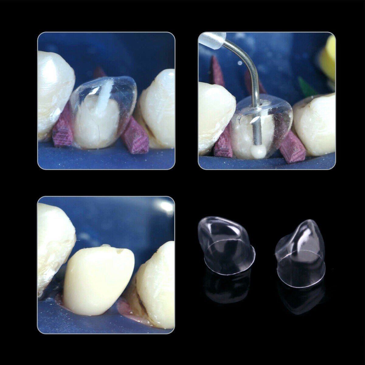 64Pcs Dental Anterior Transparent Crowns Deciduous For Adult/Kids Matrix Veneers