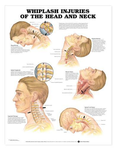 WHIPLASH Laminated Wall Chart 20″ x 26″ Classroom/Professional LFA #99989
