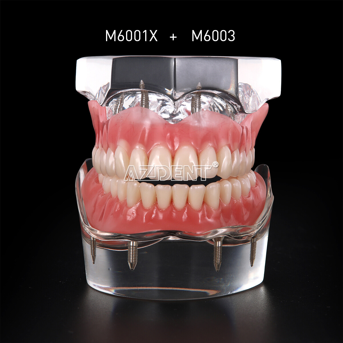 Dental Implant Teeth Model Demo Overdenture Restoration 2 / 4 Implants Upper Low