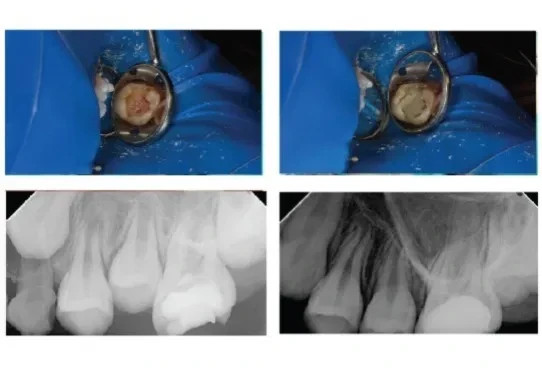 Maarc Ceraset MTA Putty Bioceramic for Root & Pulp Treatment – Free Ship