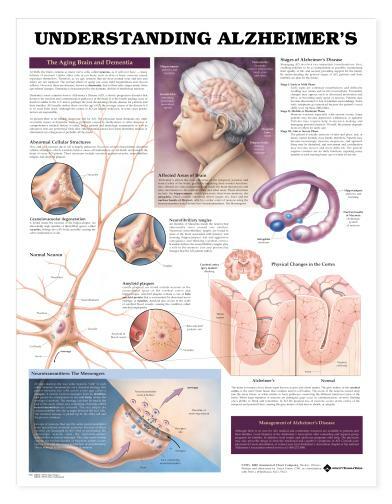 ALZHEIMERS Laminated Wall Chart 20″ x 26″ Classroom/Professional LFA #99976